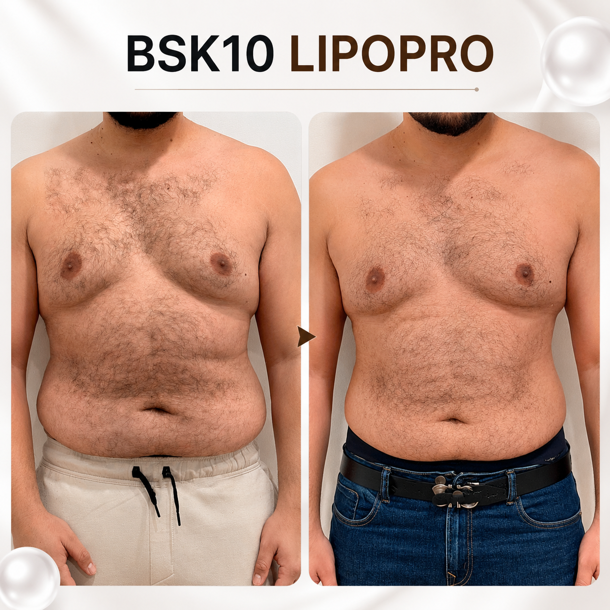 BSK10 LIPOPRO | Tratamiento corporal lipolítico para grasa localizada y remodelación